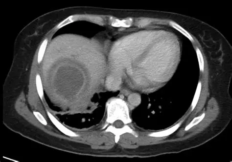 Ameba Liver Abscess Diagnosis