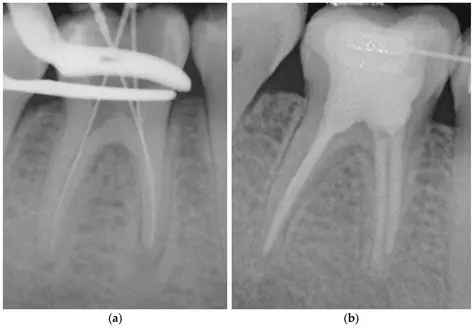 Analyze the Quality of Root Channel Filling