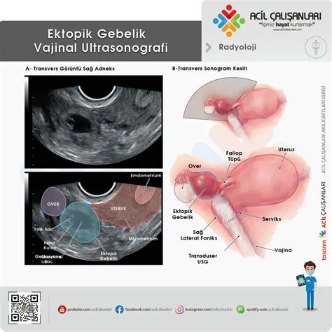 Ektopik Gebelik Soru ve Cevap