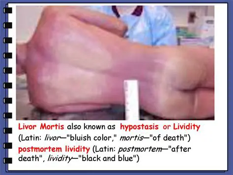 Lividity and Its Significance
