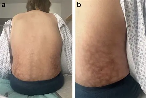 Reticulated pedunculated dermatosis
