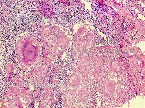 The Importance of Bajah in Diagnosing TB Lymphadenitis