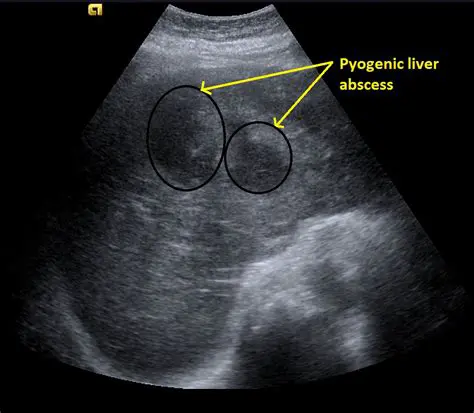 Ultrasound Diagnosis of Liver Abscess