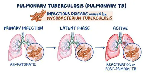 Understanding Secondary Infections in Pulmonary Tuberculosis