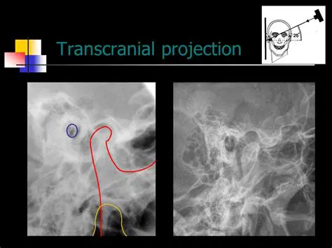 Use the transcranial projection